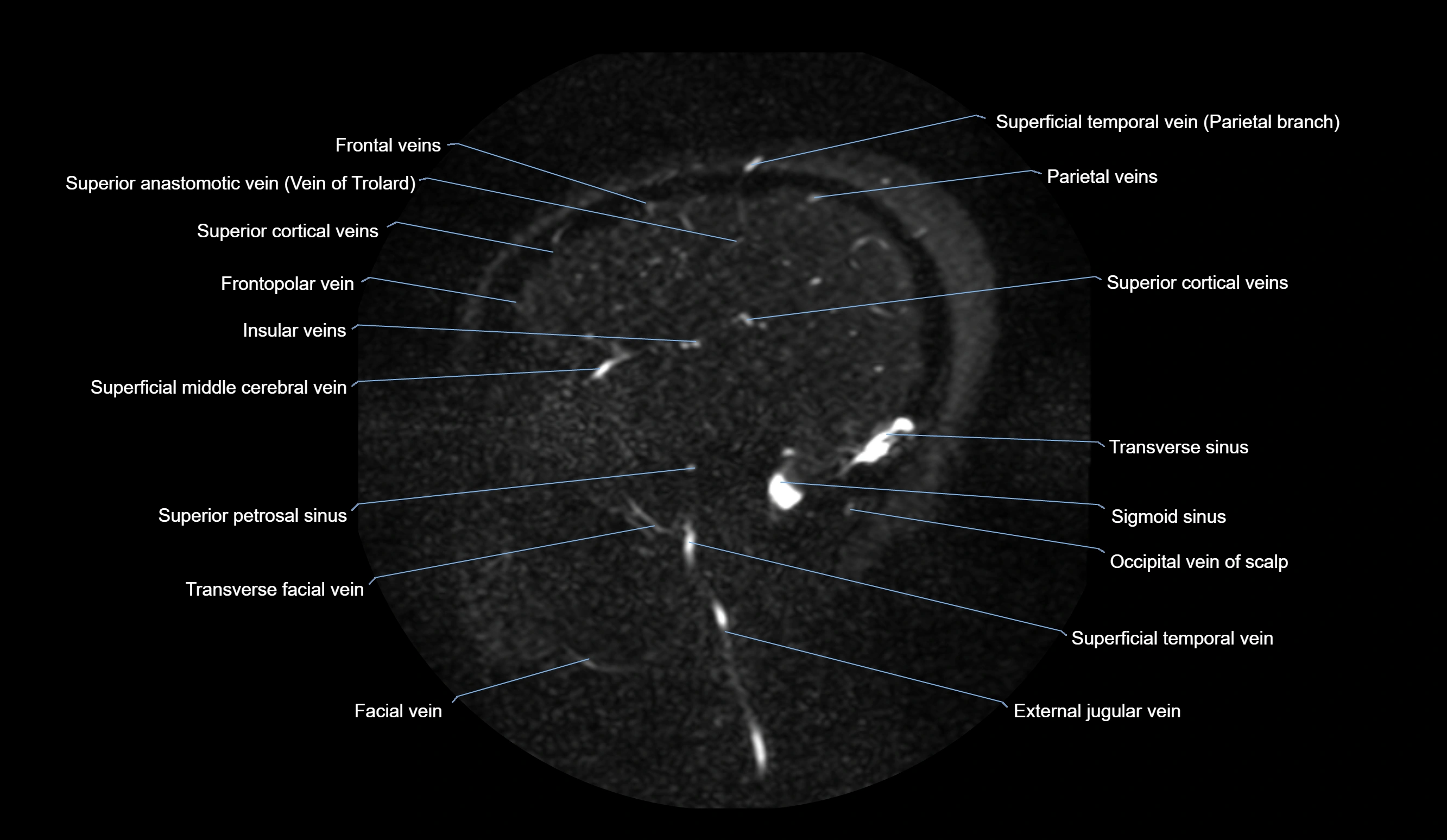 MRV brain sagittal anatomy 3T MRI labelledimages -00019.webp